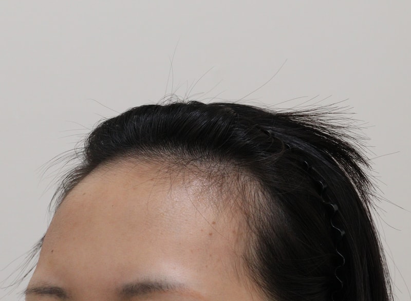 1. 수술전_2.JPG