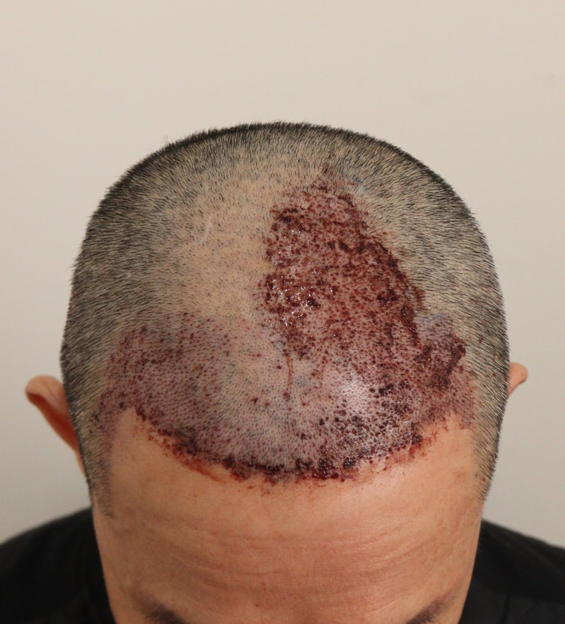 2. 수술후_1일.JPG