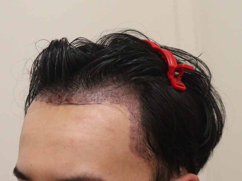 2. 수술후_1일_2.JPG