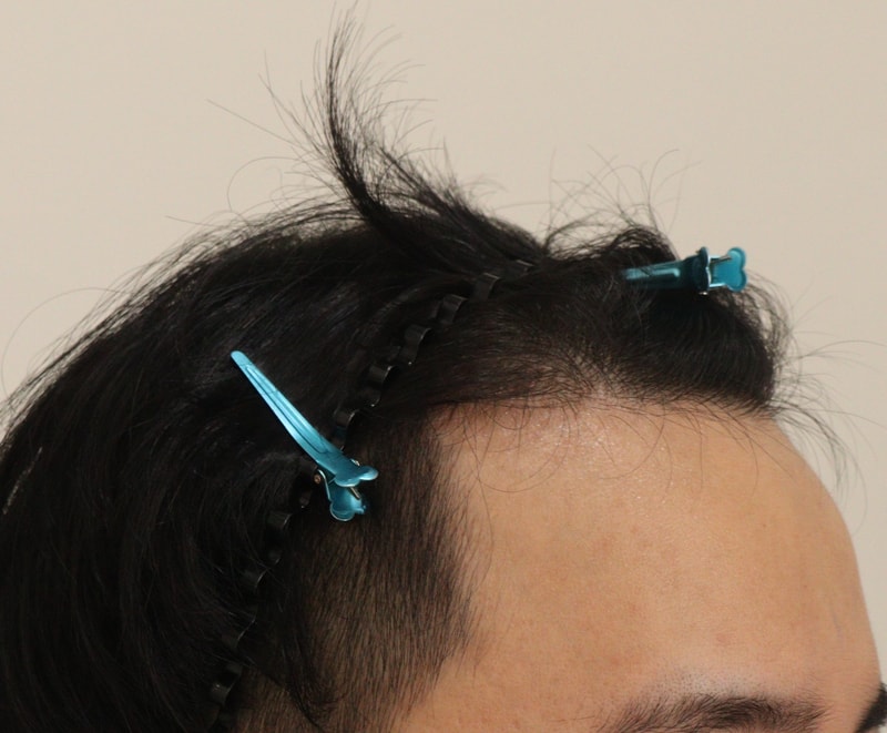 1. 수술전_3.JPG