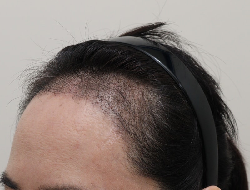 3. 수술후_3개월_2.JPG