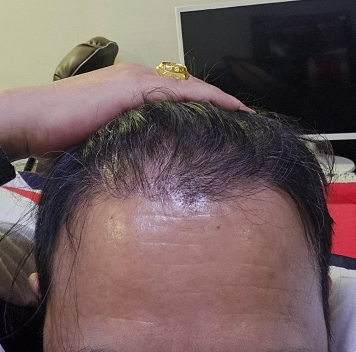 3. 수술후_3개월_셀카_2.jpg