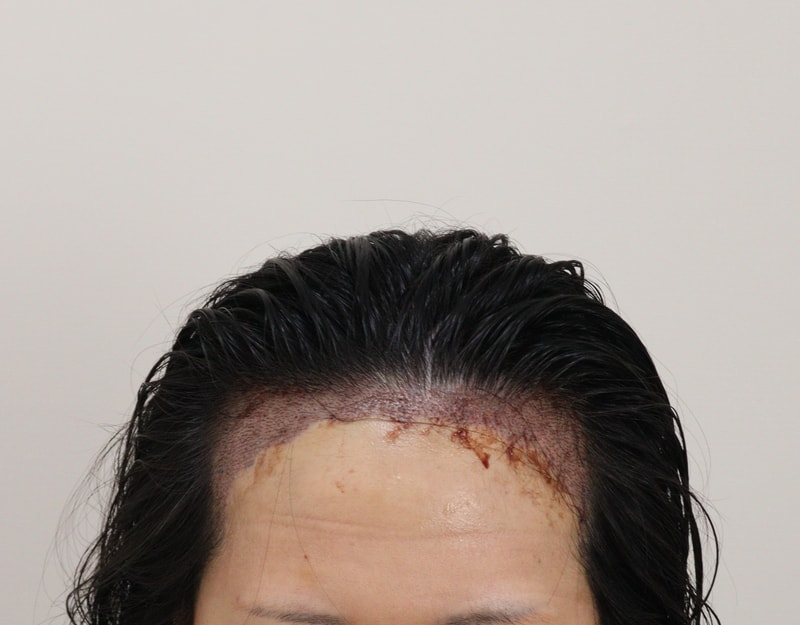 2. 수술후_1일_1.JPG