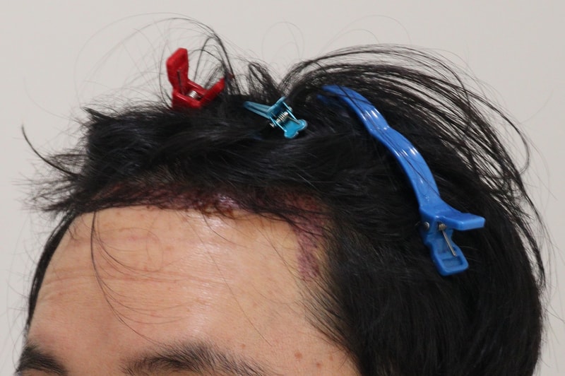 2. 수술후_1일_2.JPG