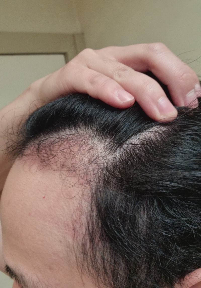 4. 수술후_3개월_셀카_2.jpg