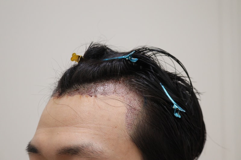 2. 수술후_1일_2.JPG