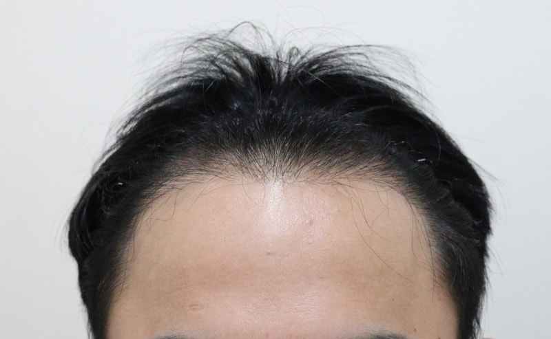It's been five months since the hair transplant reoperation.