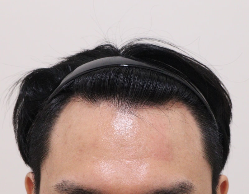 어제 비절개로 이식하고왔네요