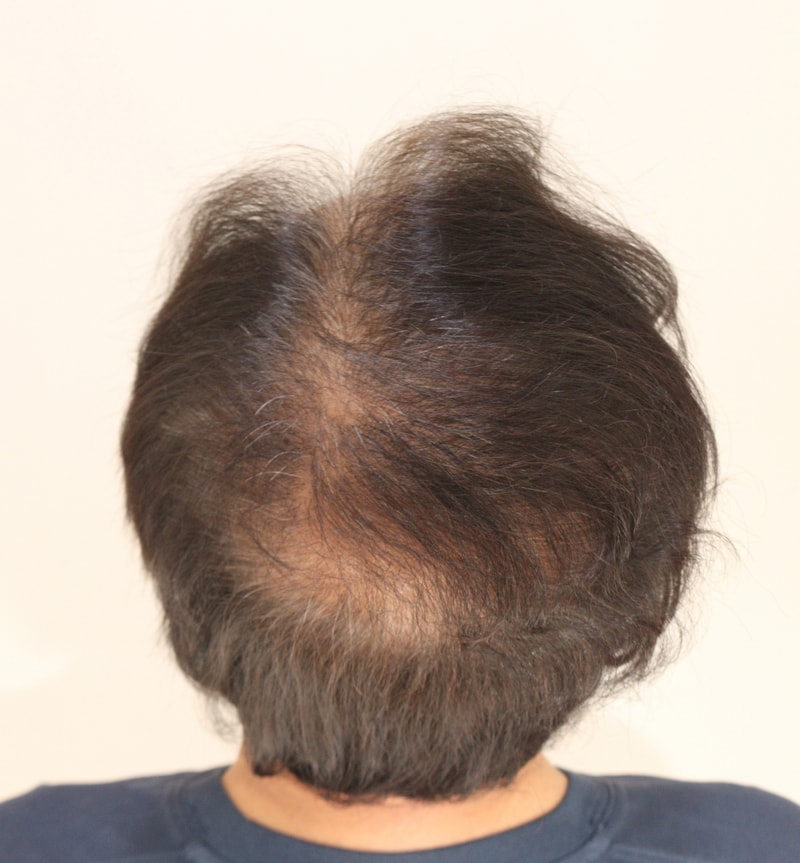 3. 수술후_3개월_2.JPG