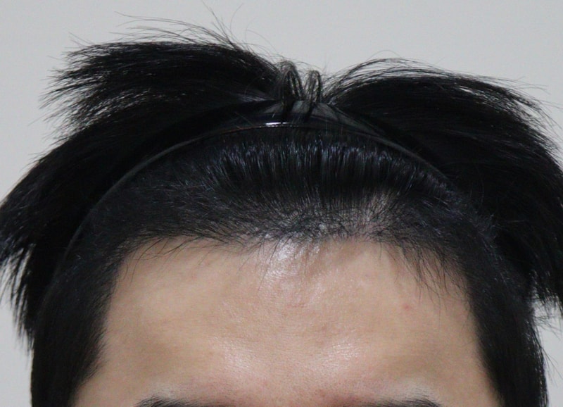 4. 수술후_6개월_1.JPG