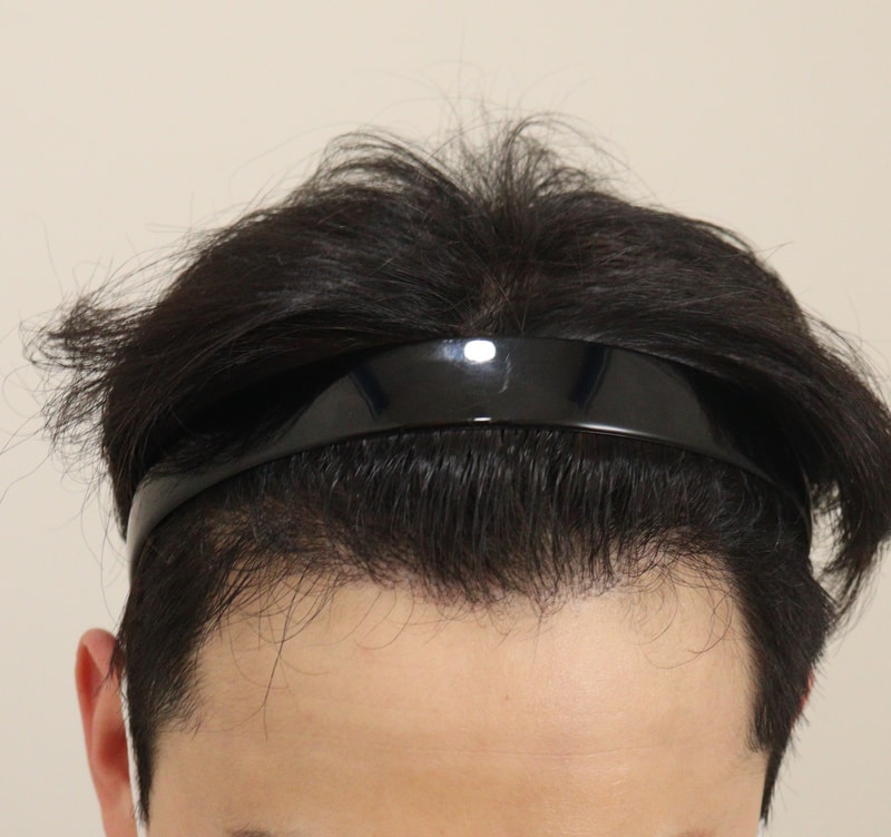 4. 수술후_6개월_2.JPG