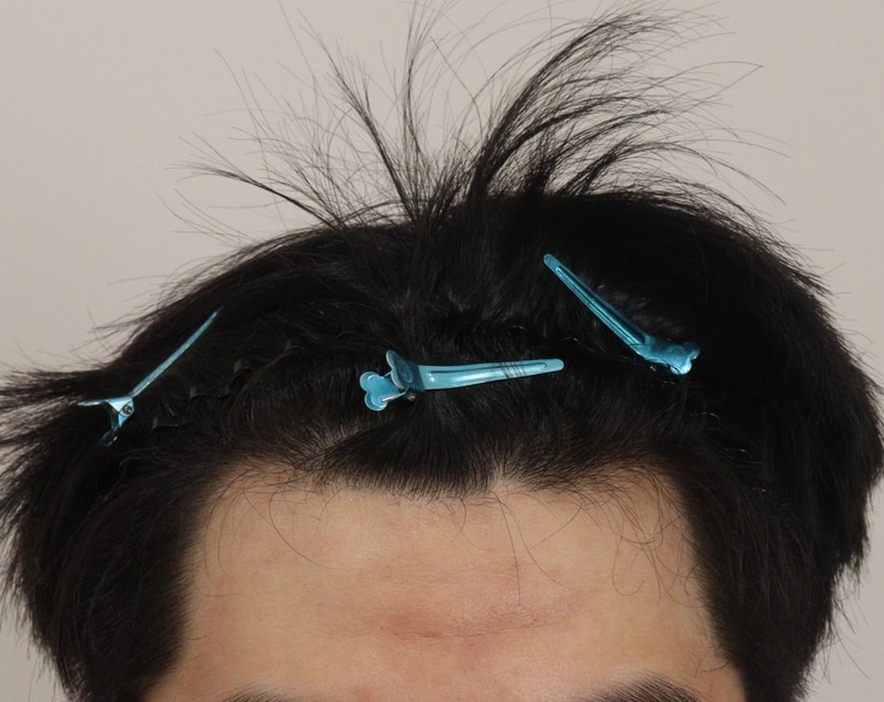 m자 깊어지기 전에 이식받길 잘한거같습니다