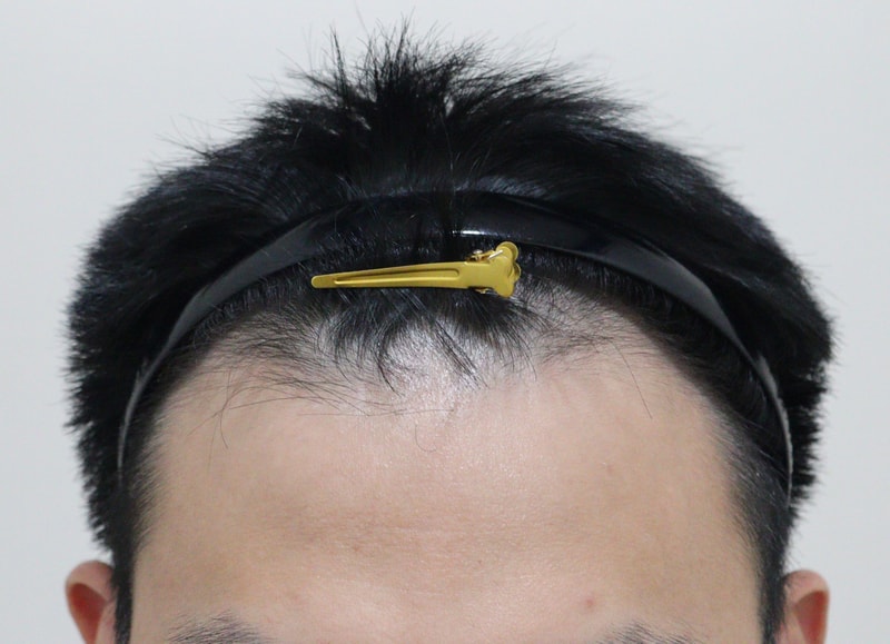非切开毛发移植1个月后期~