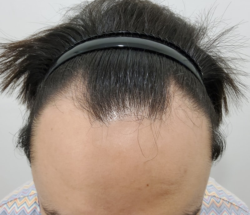 모든모의원 원장님께 비절개 모발이식 받았습니다.