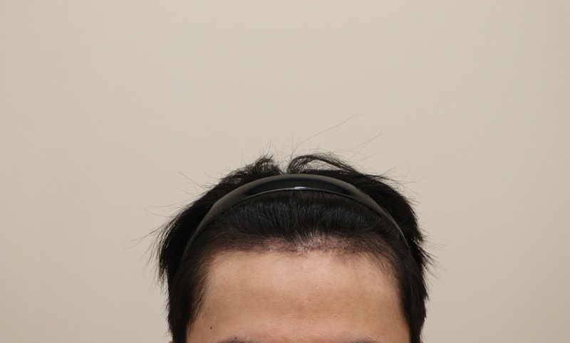 3. 수술후_3개월_1.JPG