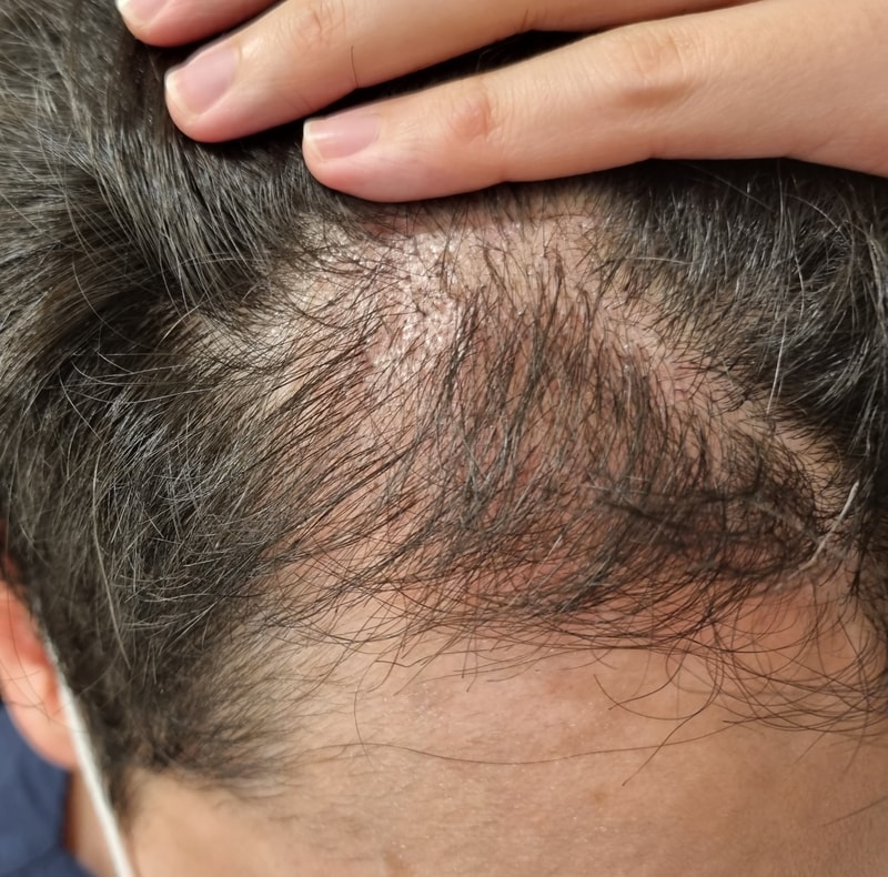 3. 수술후_3개월_셀카2.jpg