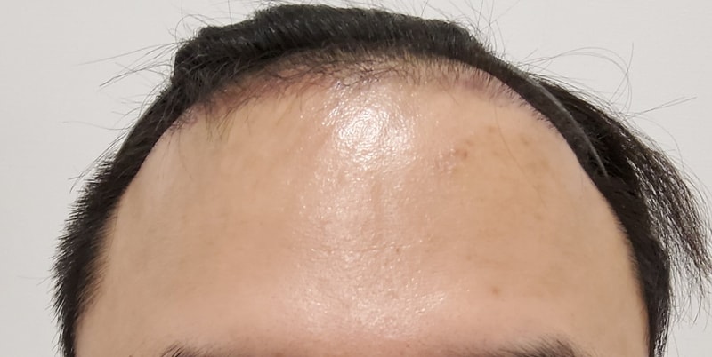 3. 수술후_3개월_1.jpg