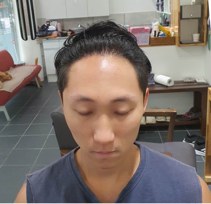 4. 수술후_6개월_셀카_1.jpg