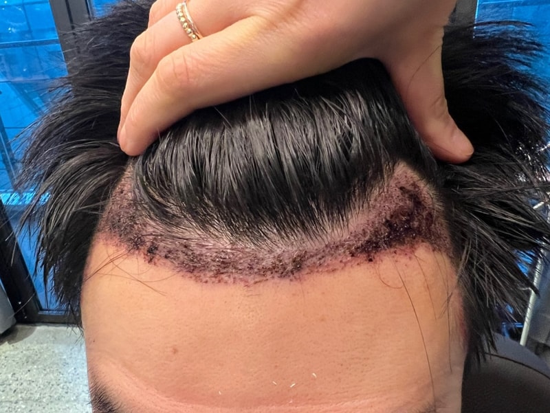 2. 수술후_1일_1.jpg