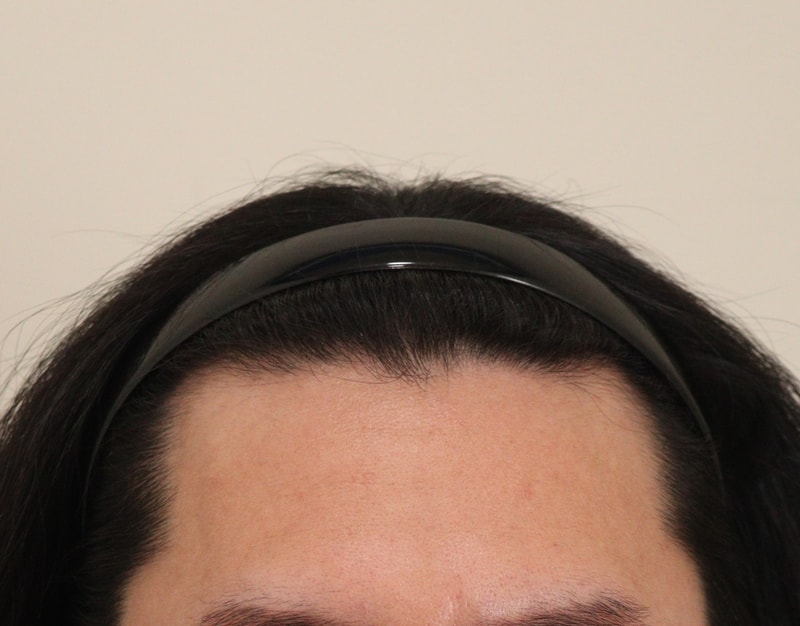 탈모아니어도 헤어라인 교정했습니다