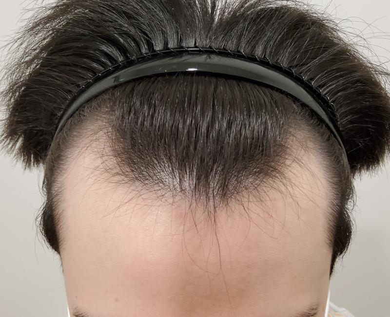 2800 hair transplant. It's the 6th month review ^^