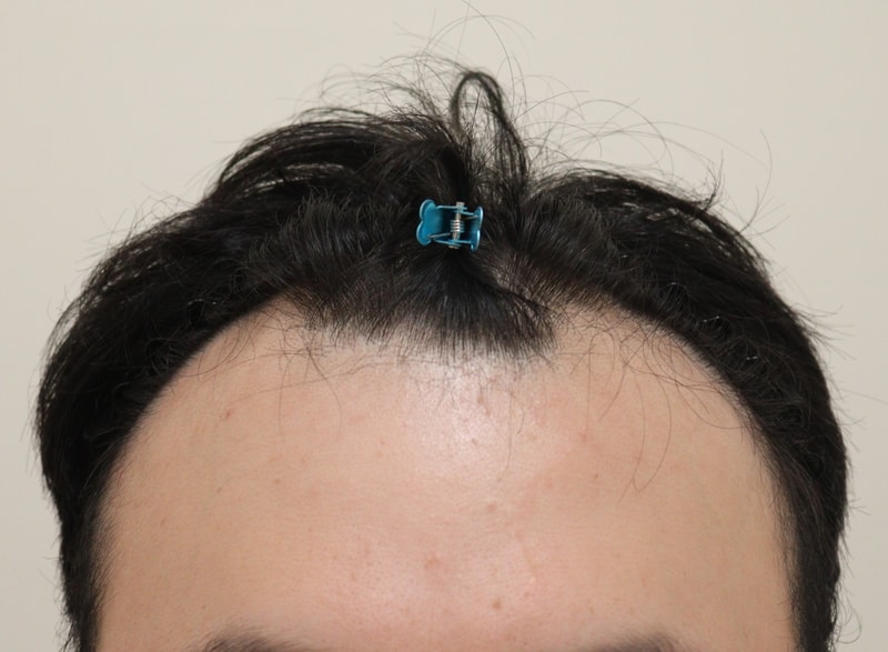 I shaved my head and got a Hair Transplant. 6th month