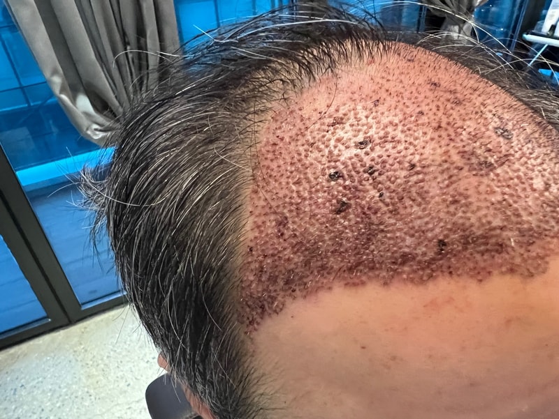 2. 수술후_1일_2.jpg