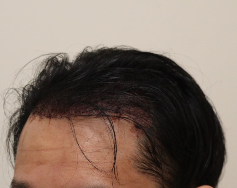 2. 수술후_1일_2.JPG