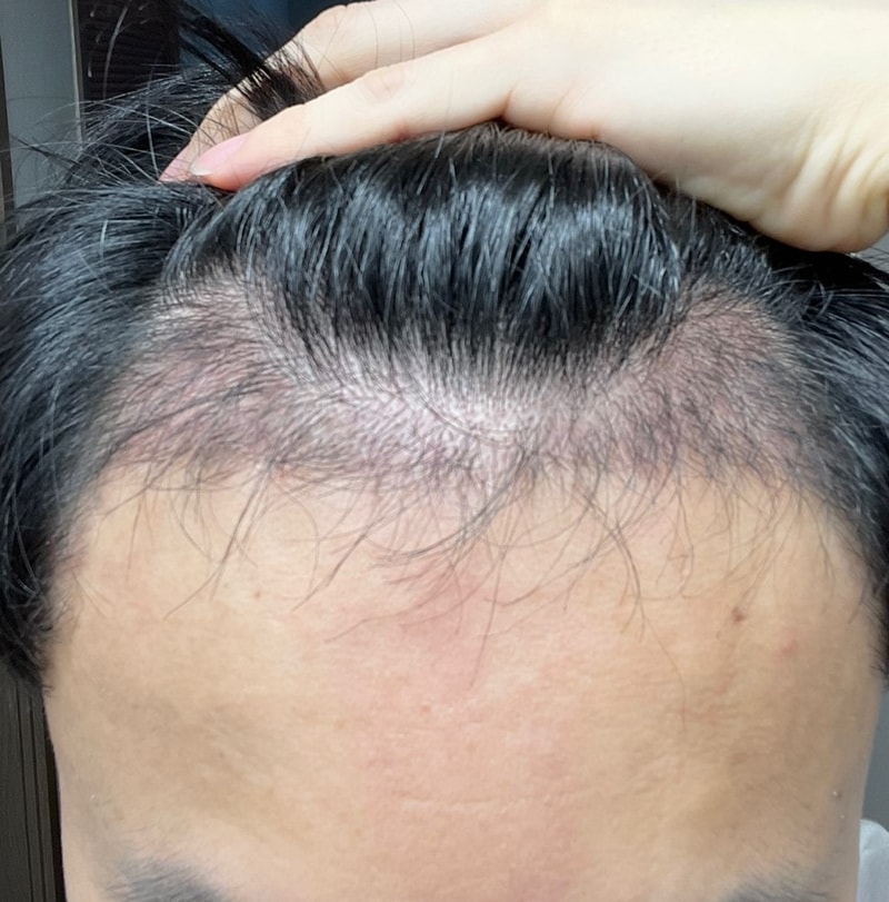 4. 수술후_3개월_셀카1.jpg