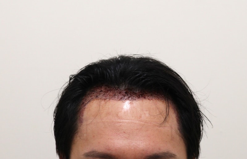 2. 수술후_1일.JPG