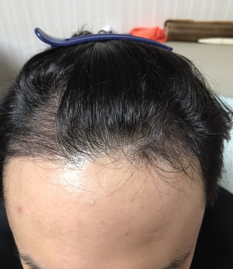 3. 수술후_3개월_셀카_1.jpg