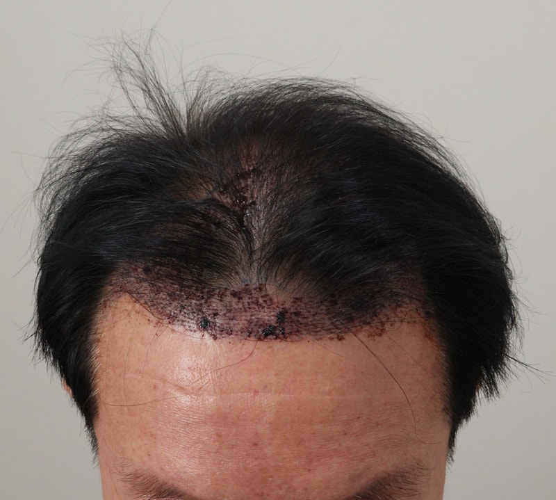 2. 수술후_1일_2.JPG