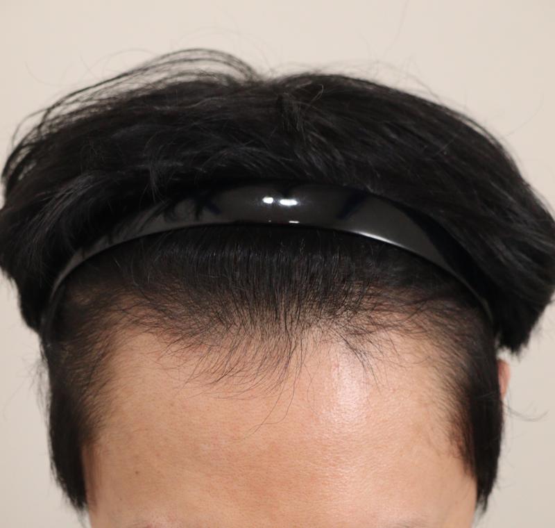 1. 수술전_1.JPG