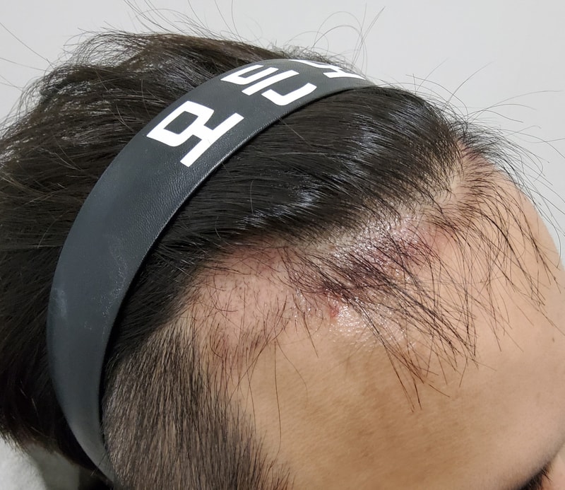 3. 수술후_3개월_4.jpg