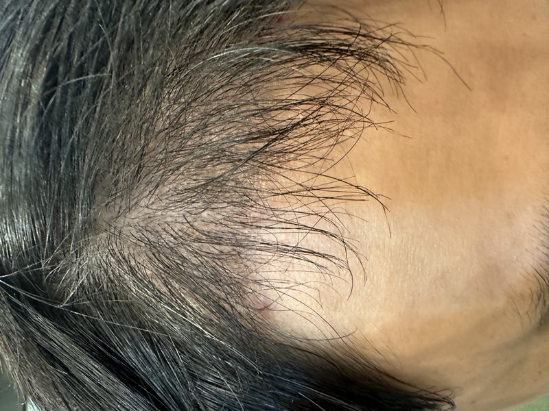 3. 수술후_3개월_셀카_1.jpg