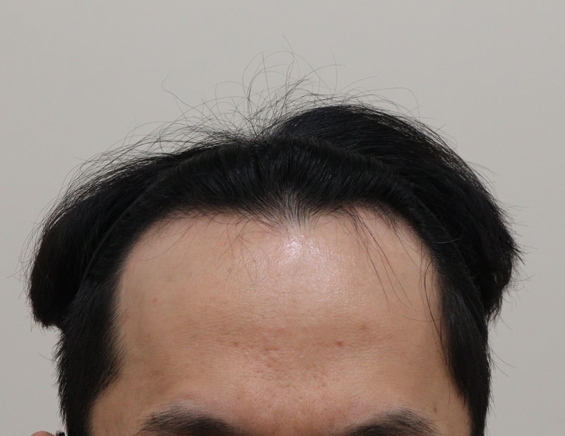 1. 수술전_1.JPG