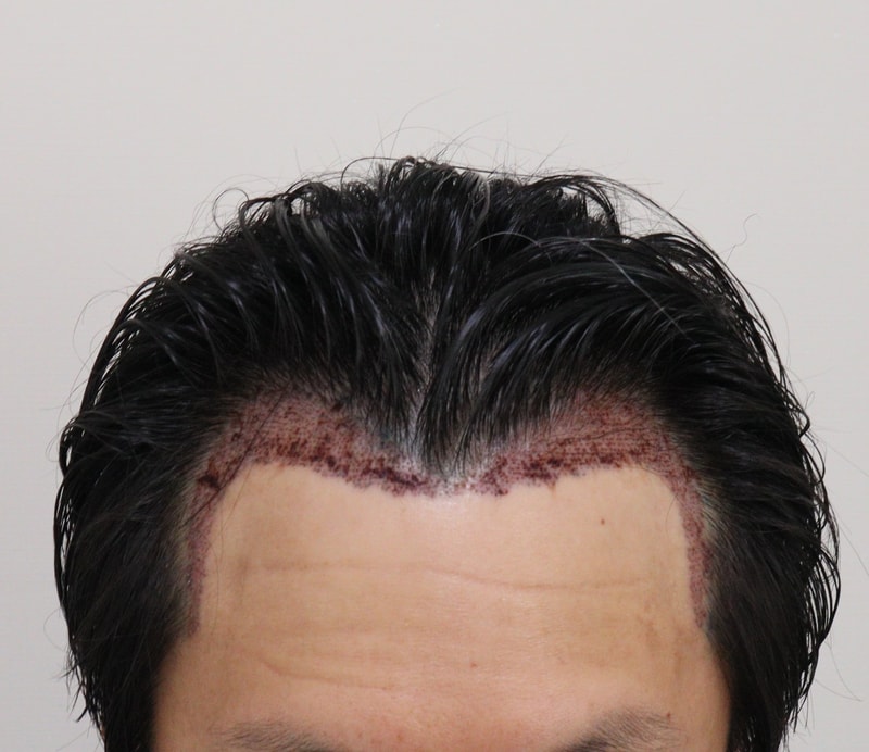 2. 수술후_1일_1.JPG