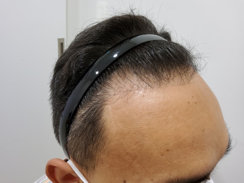 1. 수술전_3.jpg