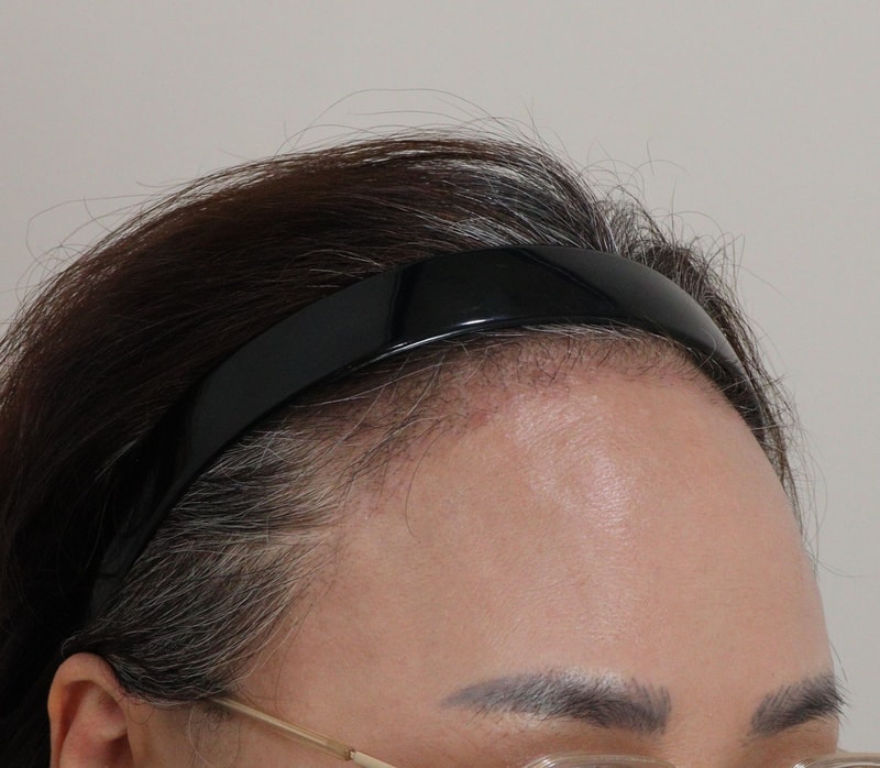 3. 수술후_3개월_3.JPG