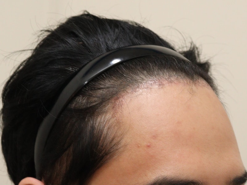 3. 수술후_1개월_2.JPG