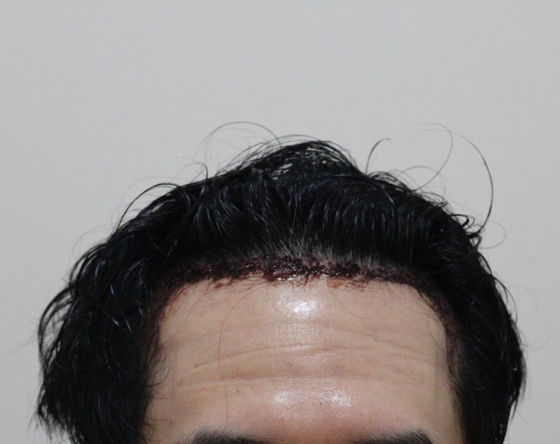 2. 수술후_1일_1.JPG