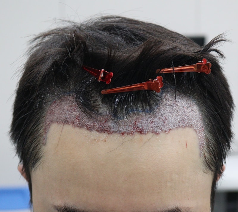 2. 수술후_즉시_1.JPG