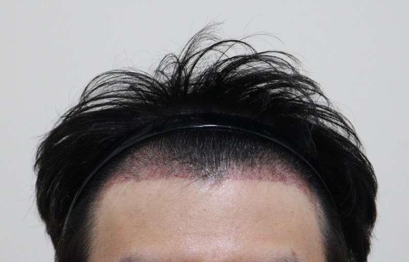 2. 수술후_1개월_1.JPG