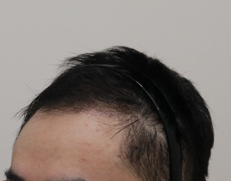 3. 수술후_3개월_2.JPG