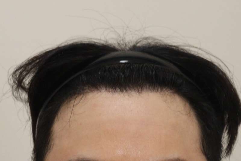 4. 수술후_6개월_1.JPG