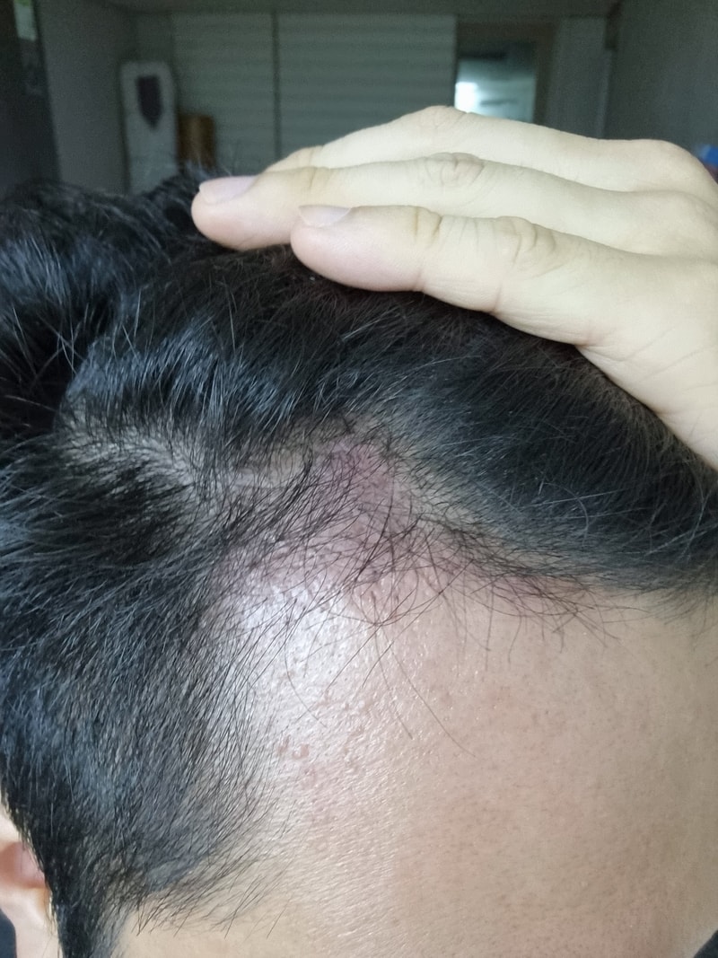 3. 수술후_3개월_셀카_2.jpg