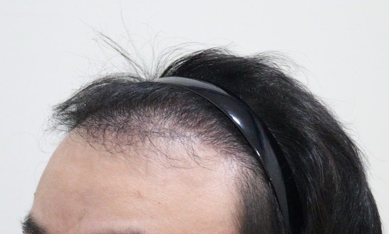 3. 수술후_6개월_3.JPG