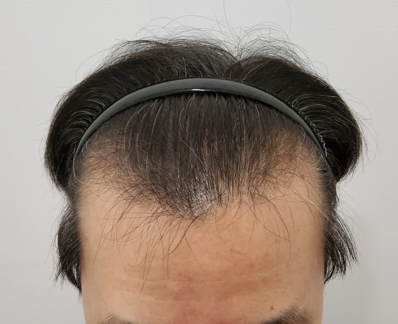 모발이식 2주 경과입니다