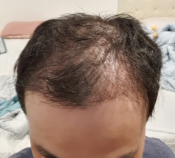3. 수술후_3개월_셀카_1.jpg
