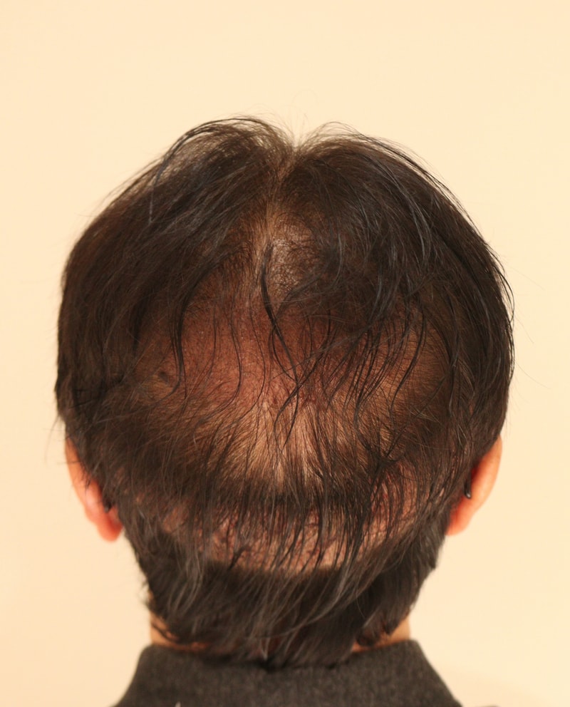 2. 수술후_1일.JPG
